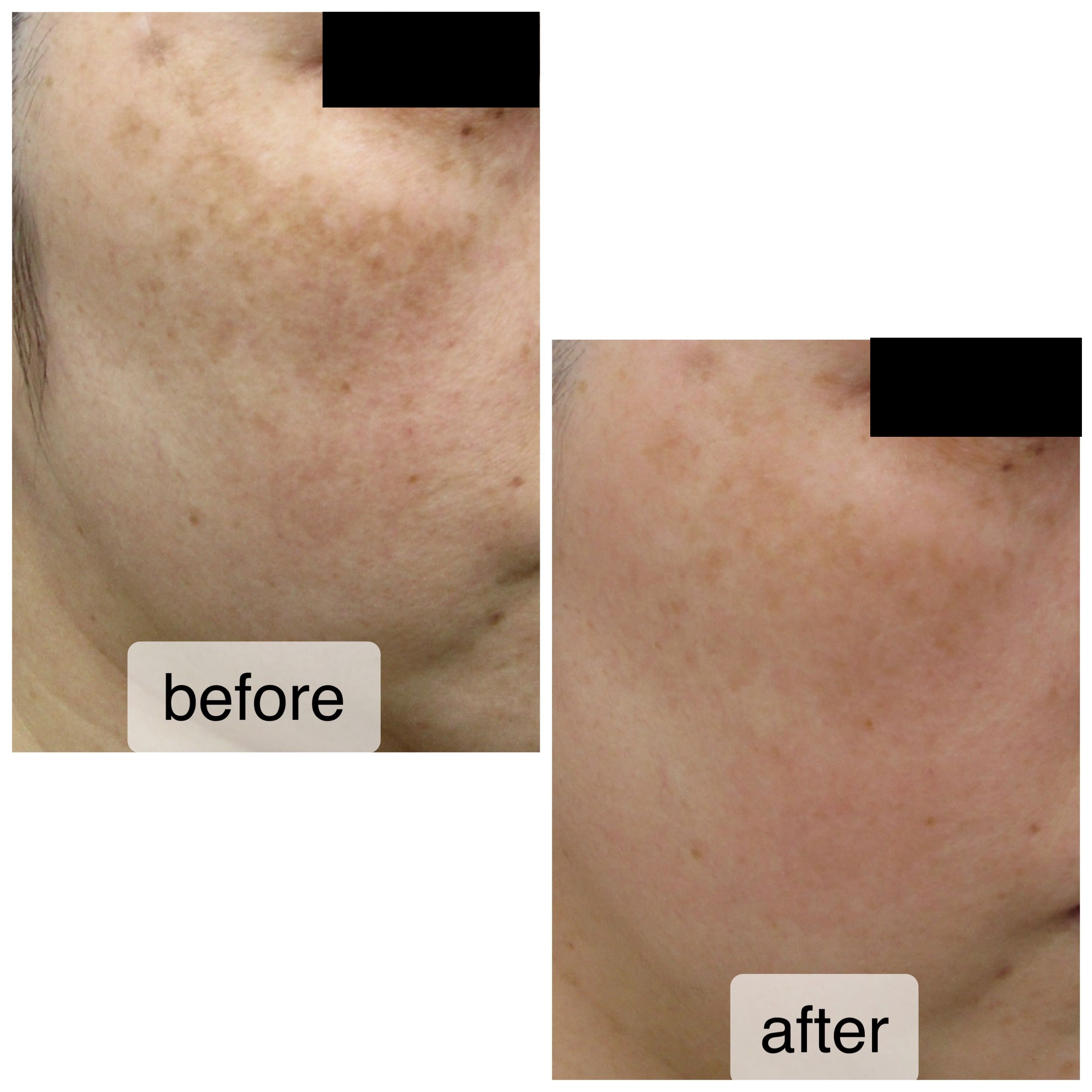 シスペラの美白効果 使用1か月 | 福岡市城南区の美容皮膚科｜タケダ