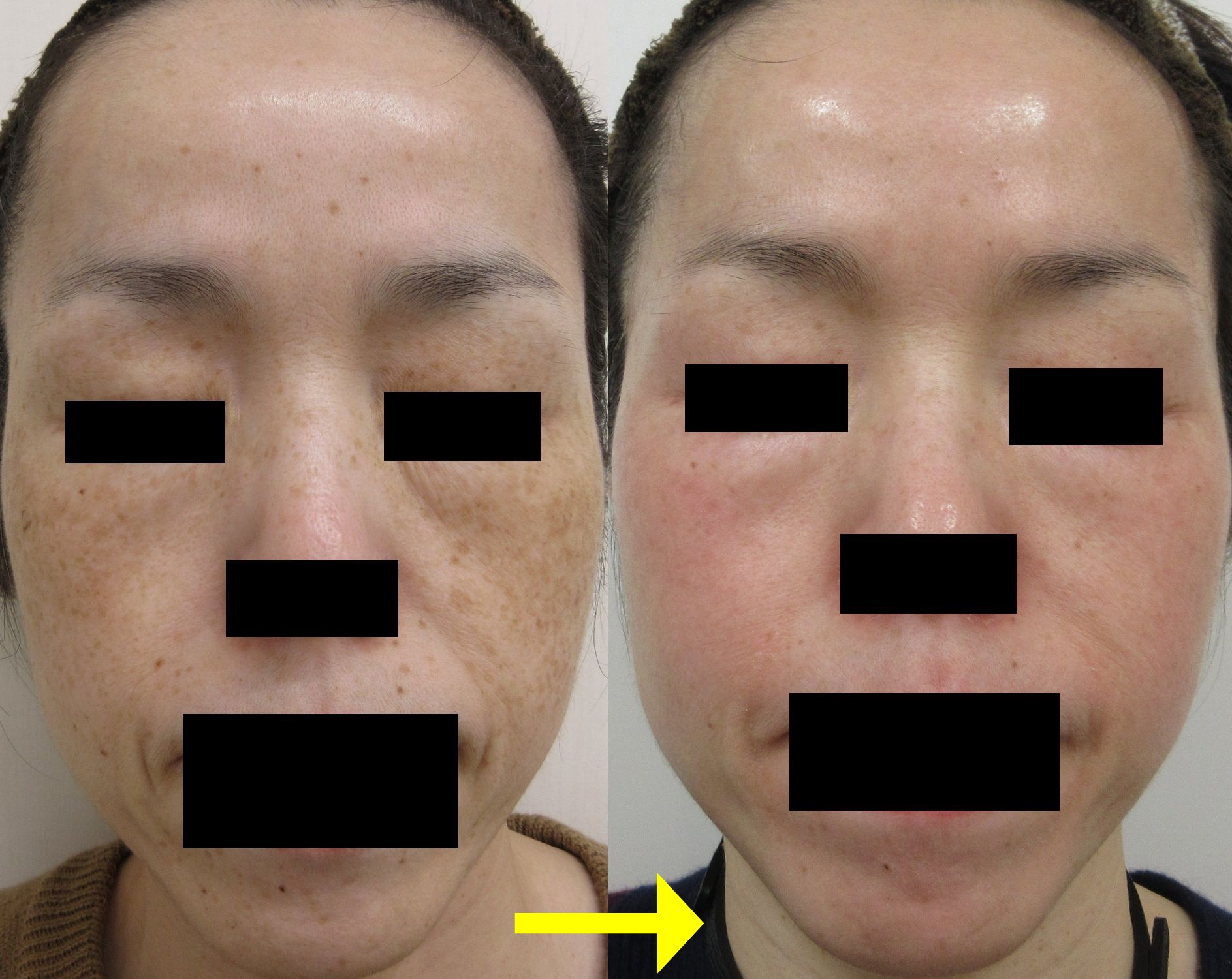 ZOスキン（ゼオスキン）3ヵ月で劇的変化 - 福岡市城南区の美容皮膚科