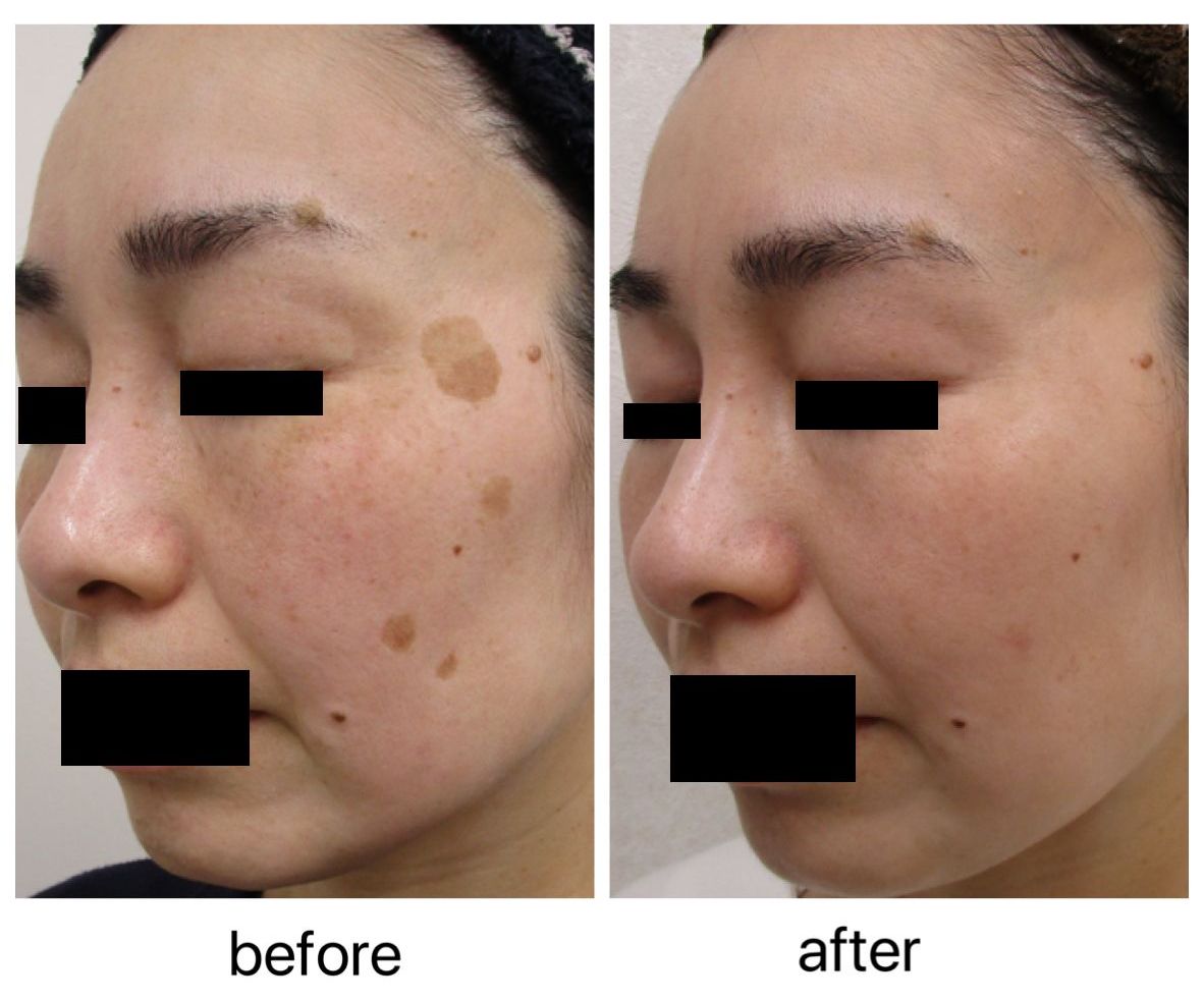 トラネキサム酸とミラミン単独の効果 - 福岡市城南区の美容皮膚科 