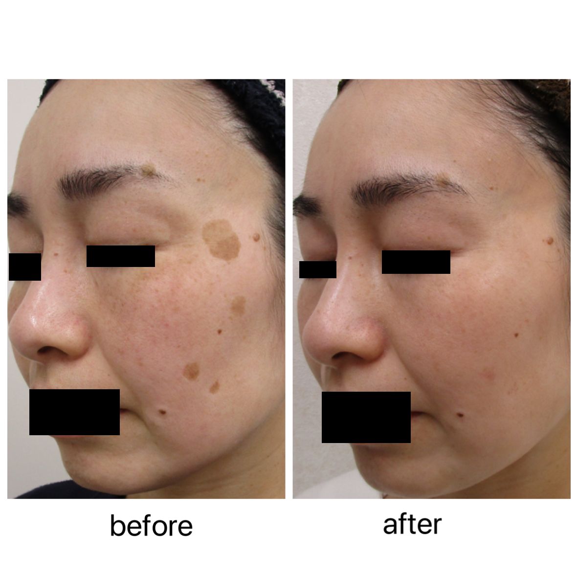 トラネキサム酸とミラミン単独の効果 - 福岡市城南区の美容皮膚科